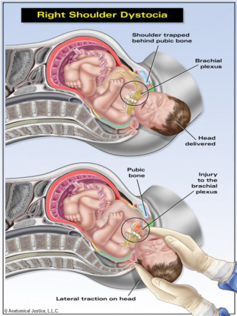 Dystocia