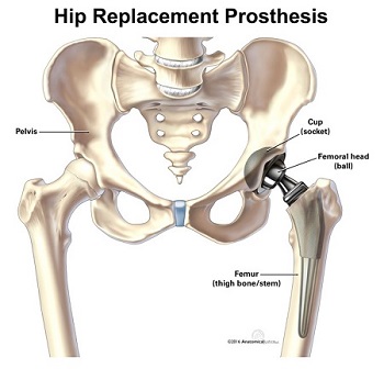 hip replacement